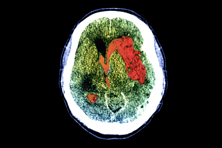 Neuroimaging: il 25% dei pazienti con lesioni cerebrali è cosciente Futuro Prossimo